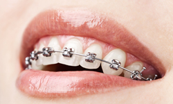 Self Ligating Braces